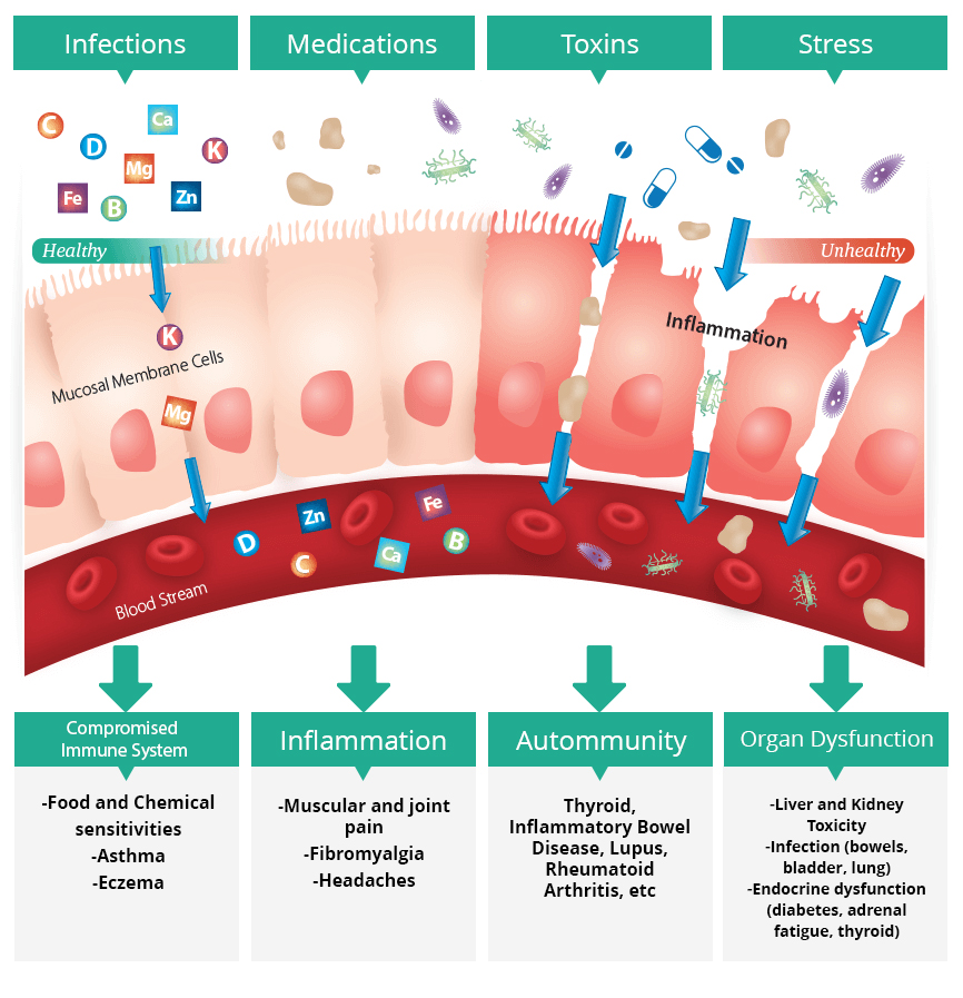 leaky gut syndrome infographic